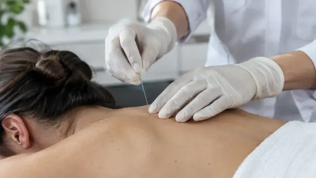 Close-up of a clinician performing dry needling on a patient's shoulder