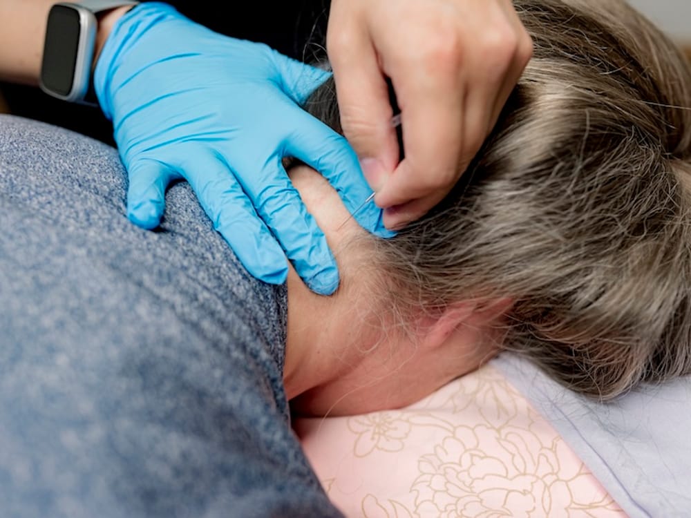 Dry needling treatment