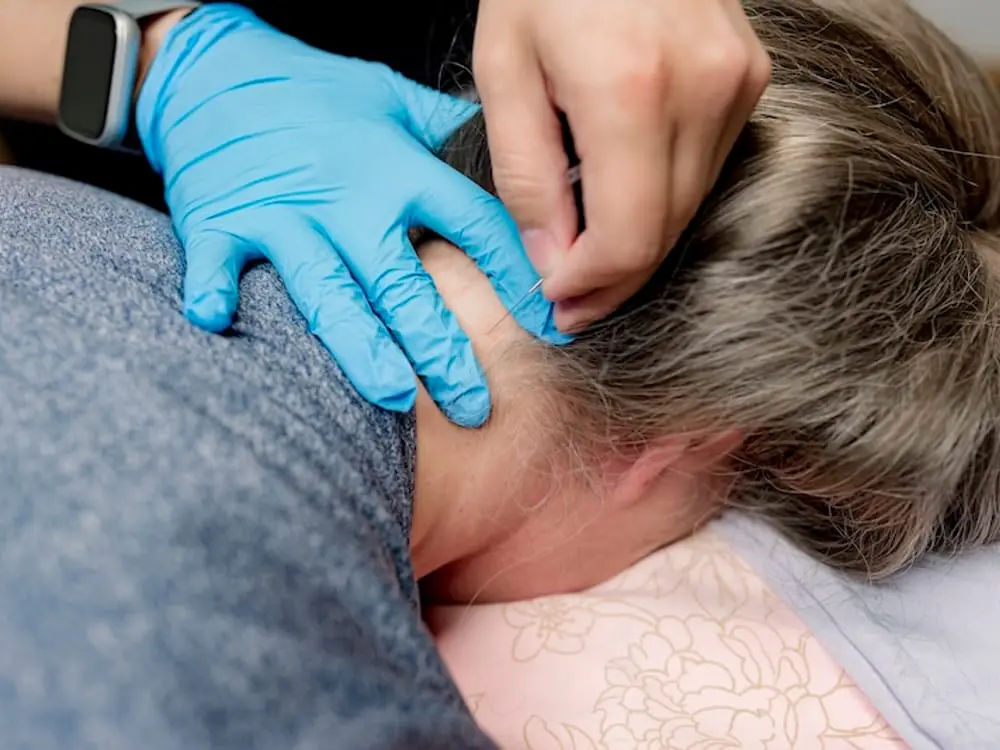 Dry needling treatment